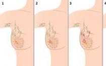 Від чого з'являється рак грудей
