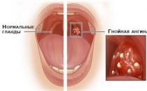 How to overcome a sore throat without difficulty?