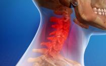 Cervical scoliosis Why is the curvature of the cervical region to blame?