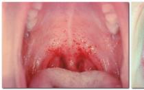 Symptoms and treatment of herpes sore throat in adults and how to detect herpes infection among others How you can have herpes sore throat