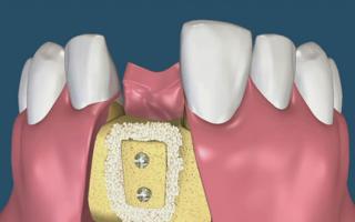 How to place dental implants and why do they hurt more?